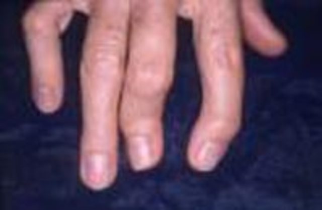 artritis psoriatica forum