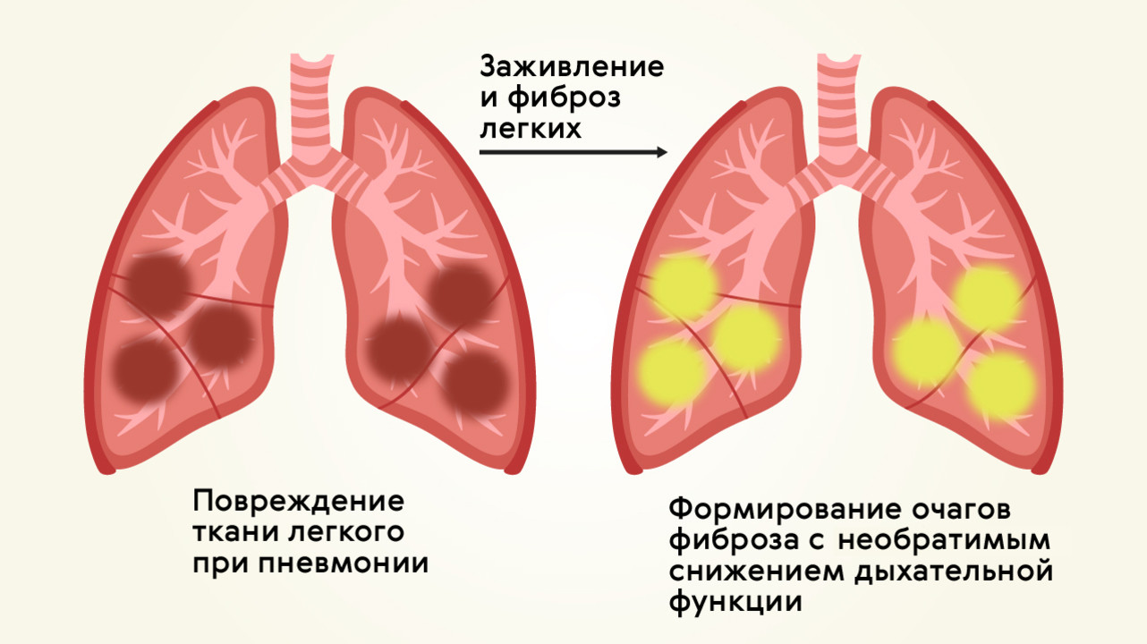 При пневмонии форма грудной клетки