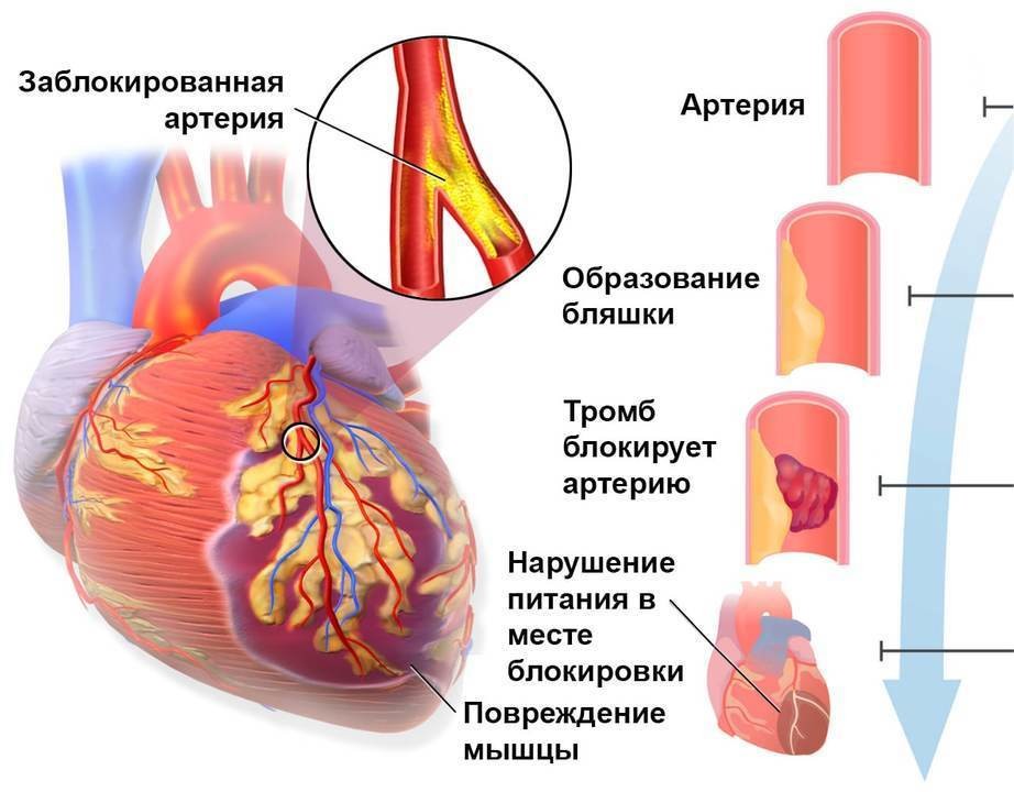 Какое сердечное давление при инфаркте миокарда