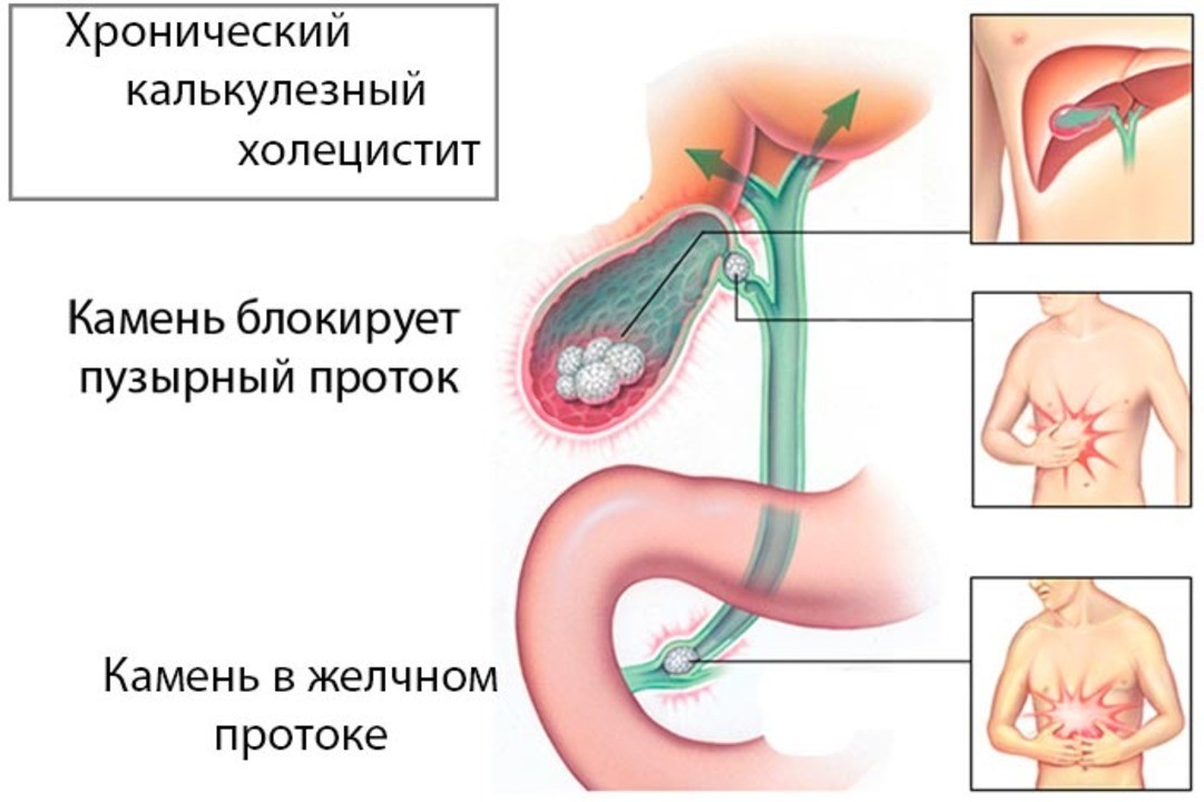 Бывает ли при холецистите диарея thumbnail