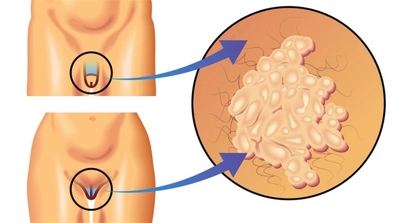 Могут ли папилломы вызывать молочницу thumbnail