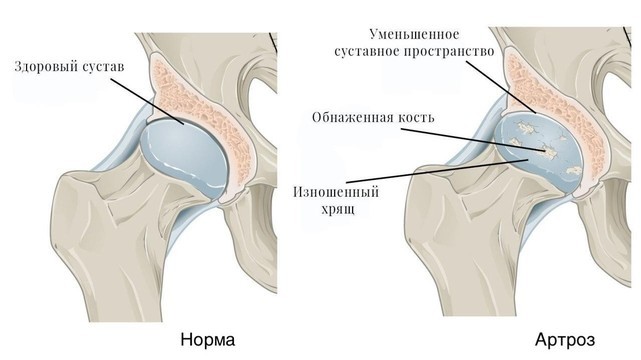 Артроз коленного сустава грыжа позвоночника