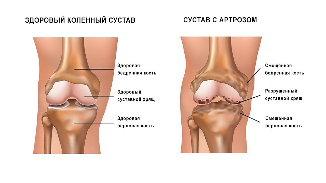 Лечение болевого синдрома коленного сустава thumbnail