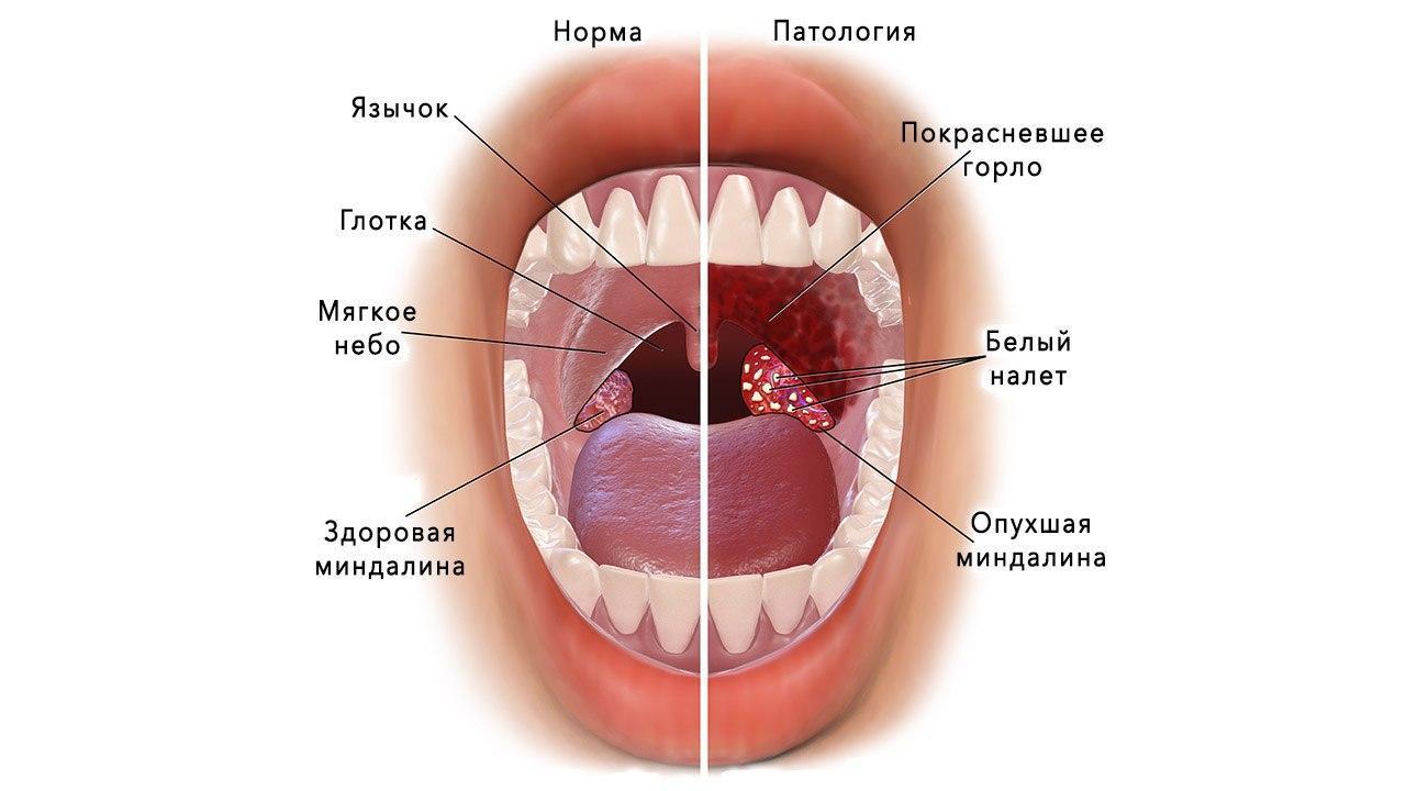 Тонзиллит: что это за болезнь и как вылечить свое горло?