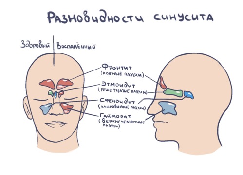 Заложенный нос и головная боль: причины