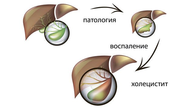 Холецистит у детей презентация