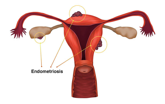 Понос перед месячными при эндометриозе