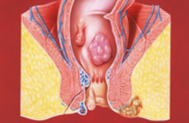 Геморрой лечение геморроя колопроктология thumbnail