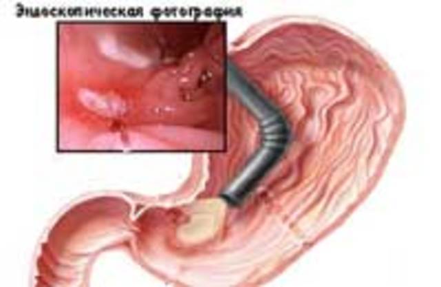 Хронический гастрит: диагностика и лечение. Гастроэнтерология