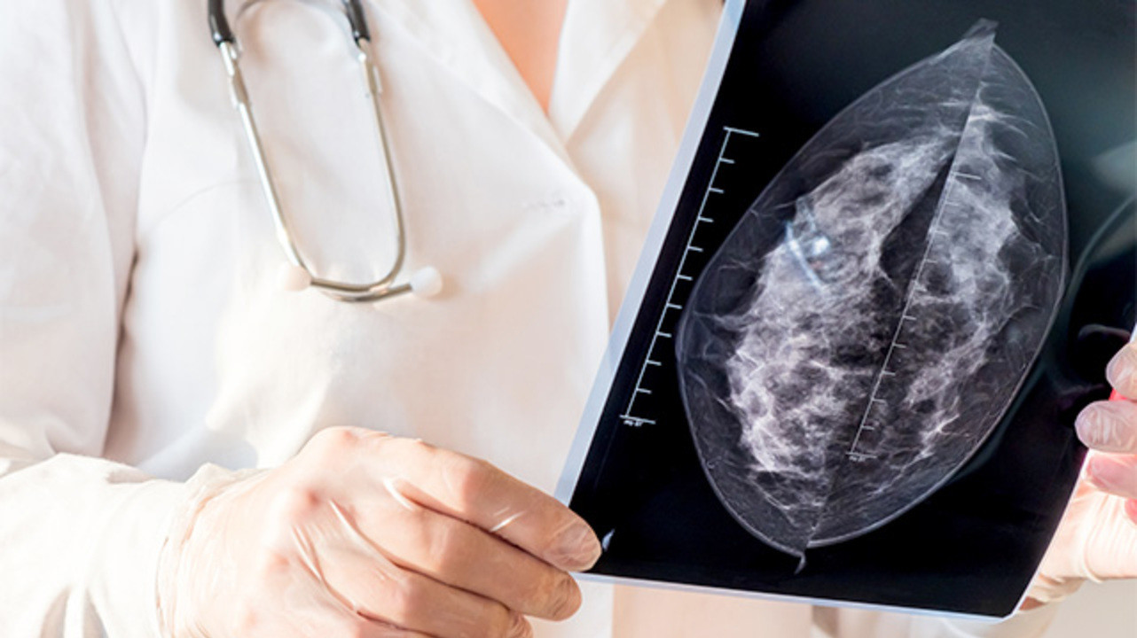 Рак молочной железы: об этом нужно знать