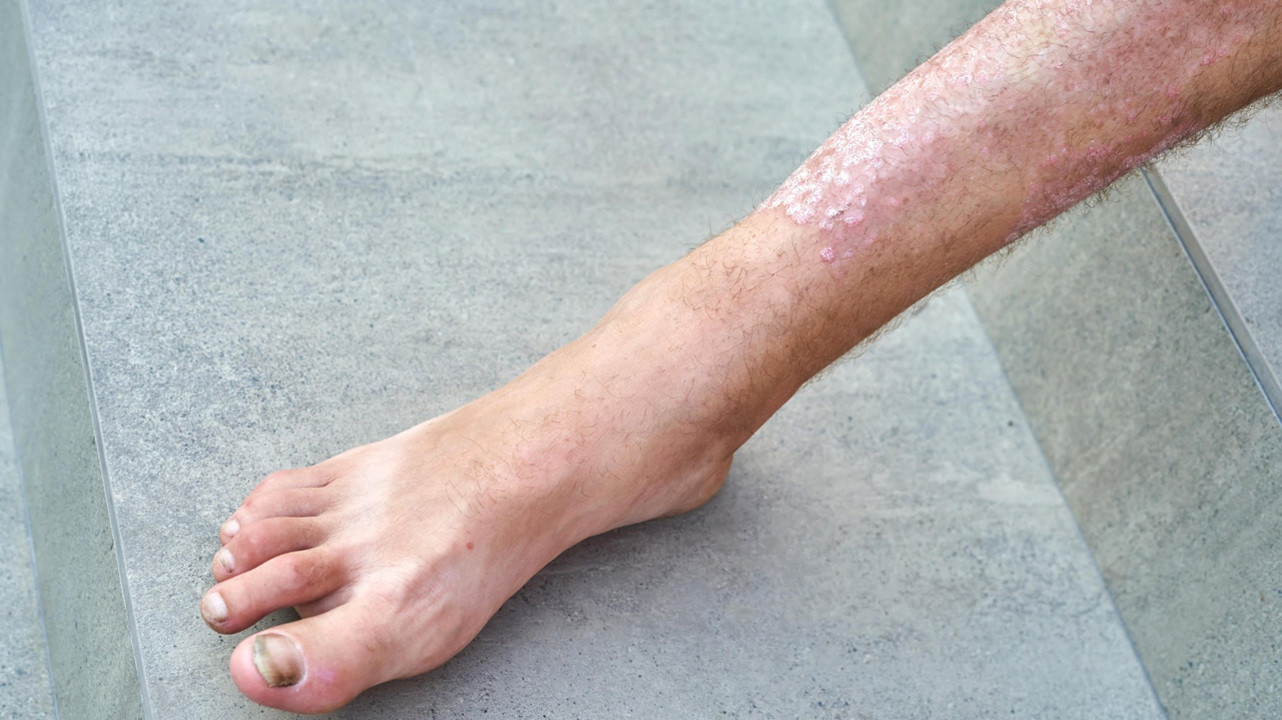 Шелушение кожи на ногах и руках: причины