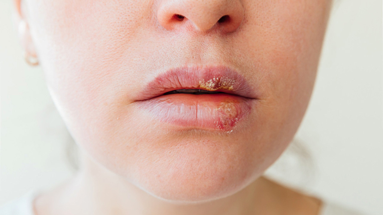 Герпес на губах: чем лечить простуду на губе.