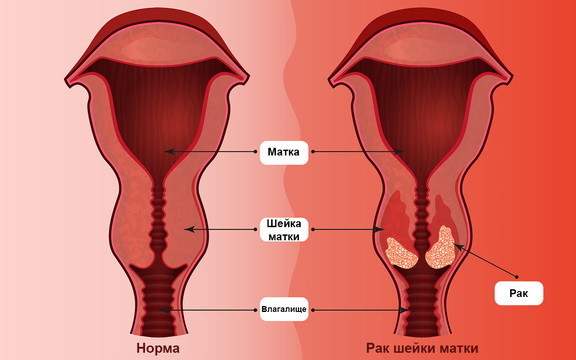 Цервицит (воспаление шейки матки): симптомы и лечение