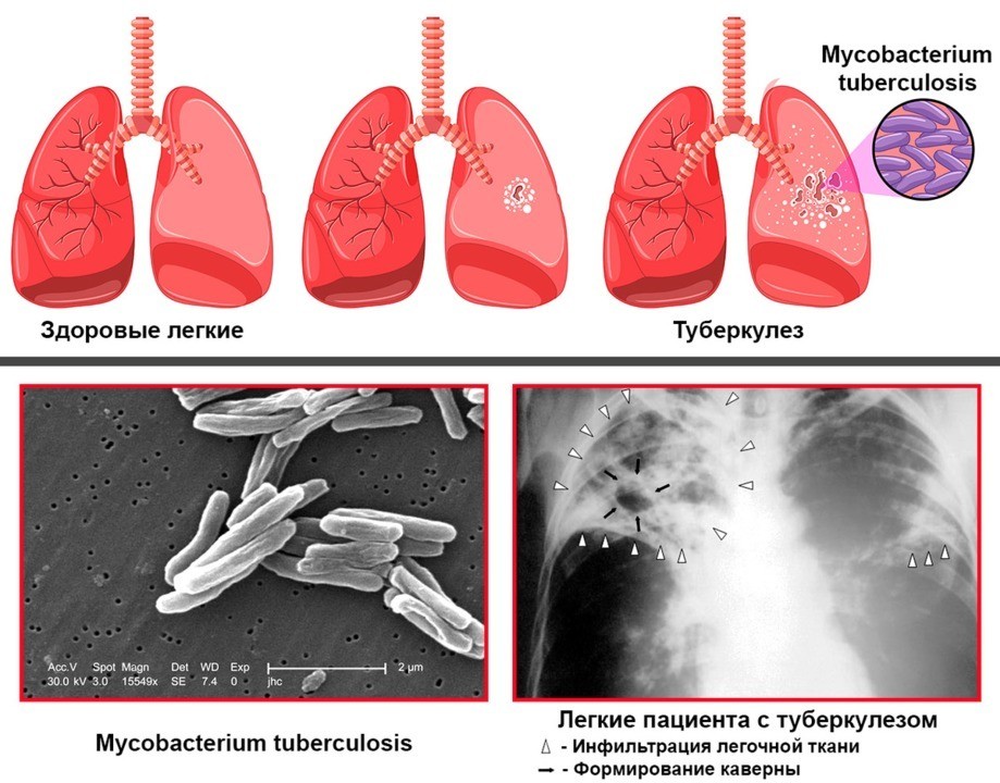 Причины развития туберкулеза