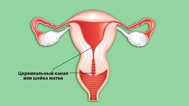 Эрозия шейки матки: первые симптомы и как лечить