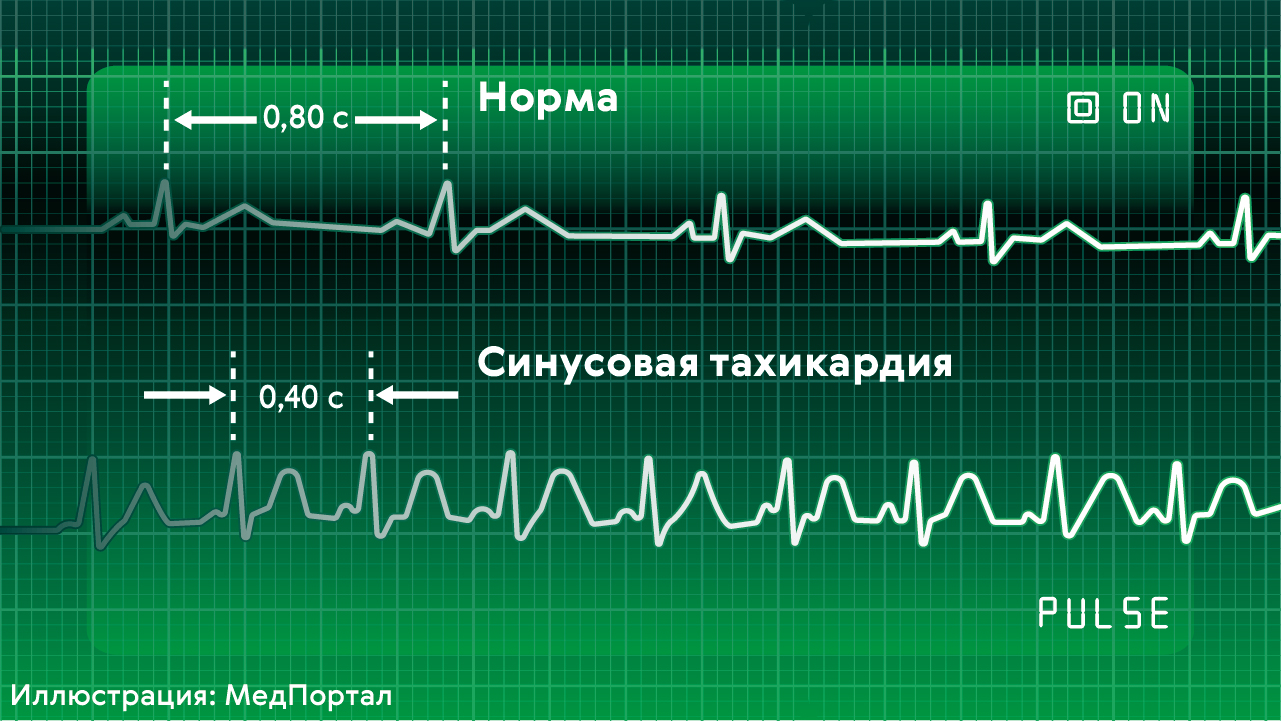 Сон сильное сердцебиение. Тахикардия фото. Кардиограмма при высоком пульсе. Пульс при тахикардии. Усиленное сердцебиение.