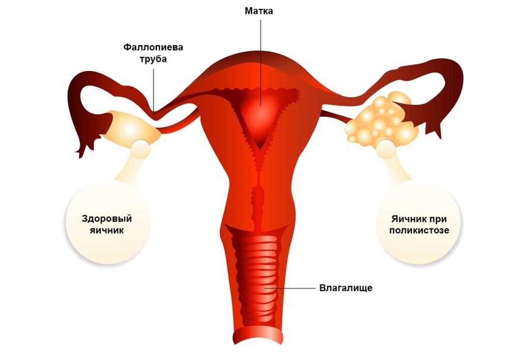 Почему болят яичники у женщин - причины и лечение