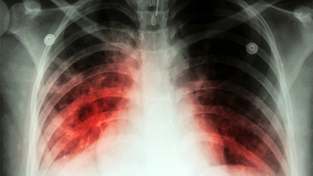 Лекарственно-устойчивый туберкулез