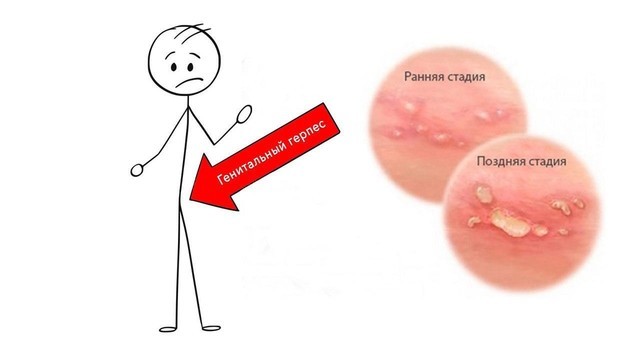 Воспаление от генитального герпеса