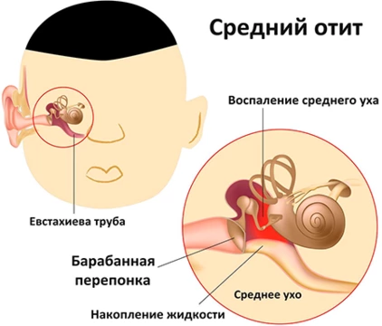 Лечение боли в ушах при простуде