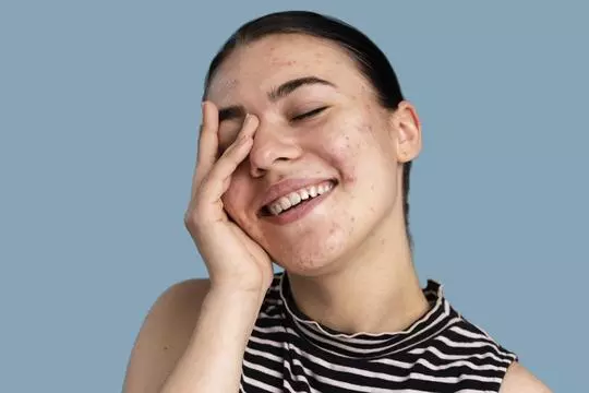 Изотретиноин и другие ретиноиды при акне: полный разбор пользы, мифов и правил применения