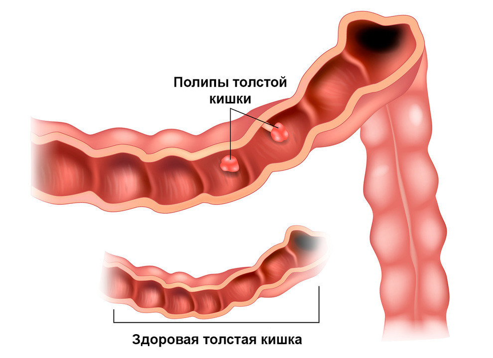 Рак прямой кишки рисунок