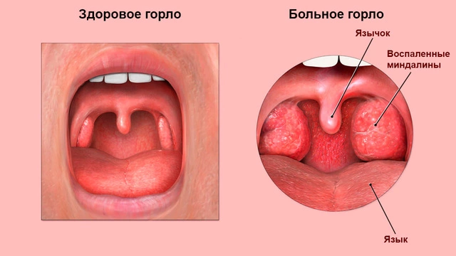 Здоровые и воспаленные миндалины