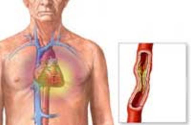 Кардиологический для больных с инфарктом миокарда что такое thumbnail