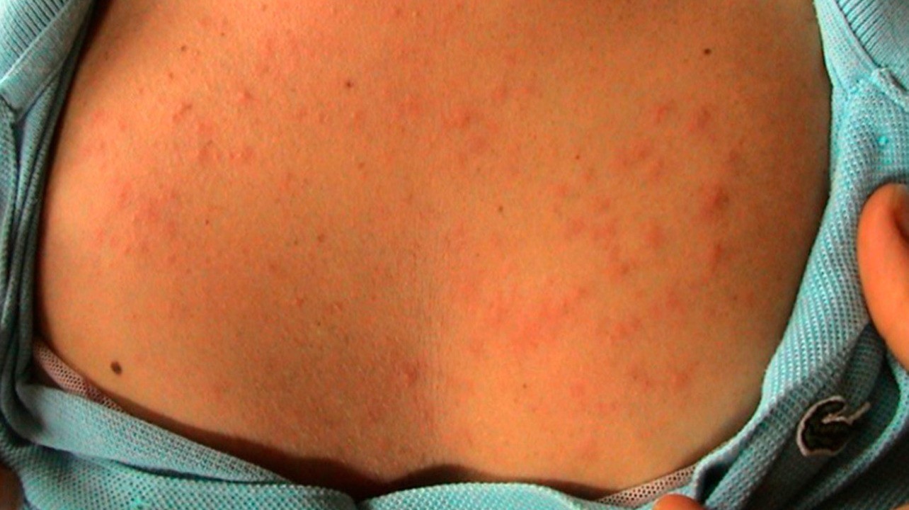 Аллергические кожные реакции - симптомы, причины и лечение