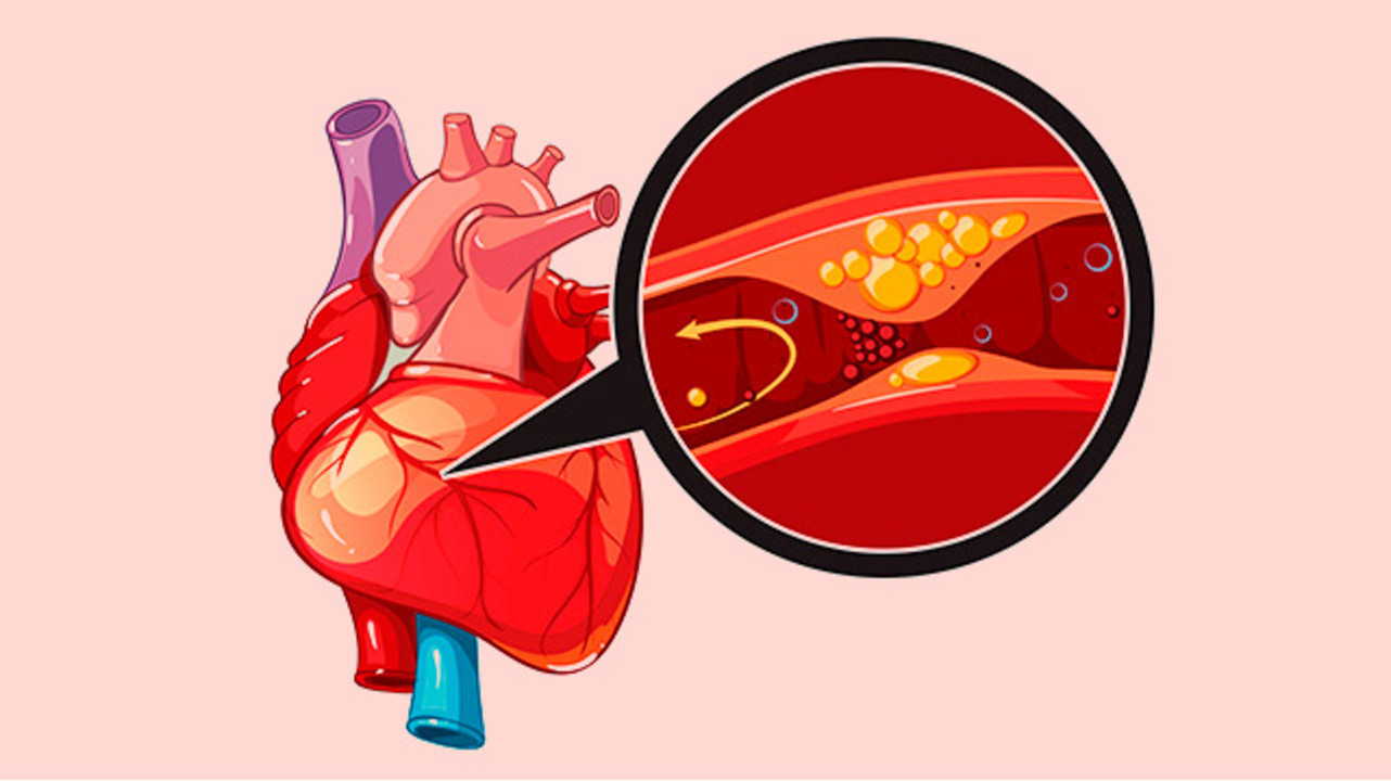 Ишемическая болезнь сердца (ИБС) 