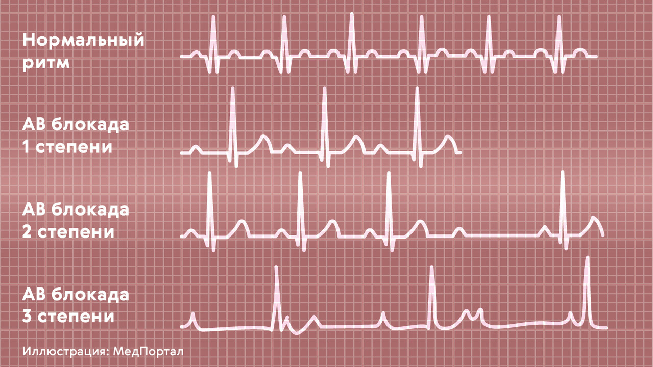 Общие причины нарушений сердечного ритма