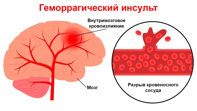 Рисунок 1. Геморрагический инсульт. Изображение: freepik.com