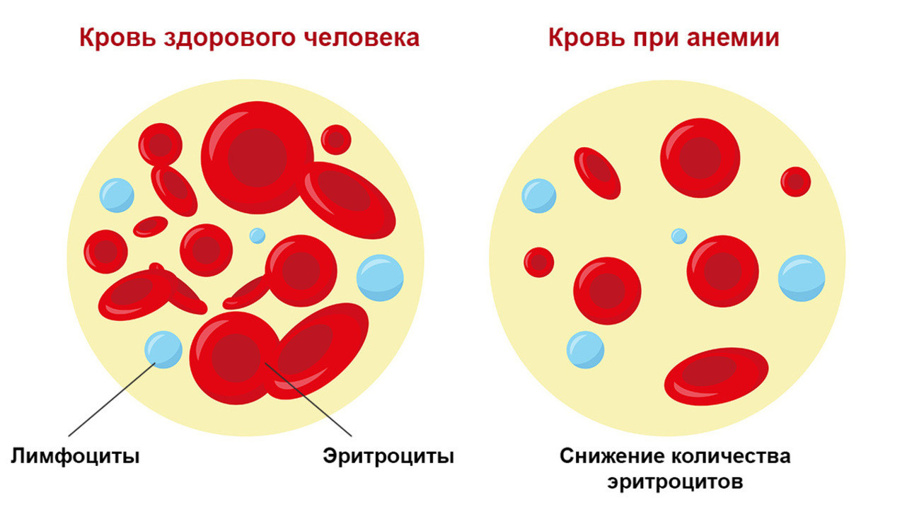 Анемии постгеморрагическая гемолитическая. Постгеморрагическая анемия гемоглобин. Эритроциты при железодефицитной анемии. Железодефицитная анемия картина крови. Гемолитическая анемия картина крови.