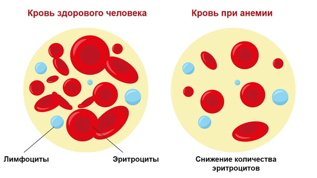 Лечение анемии в Киев: цена на лечение анемии в клинике Оксфорд Медикал