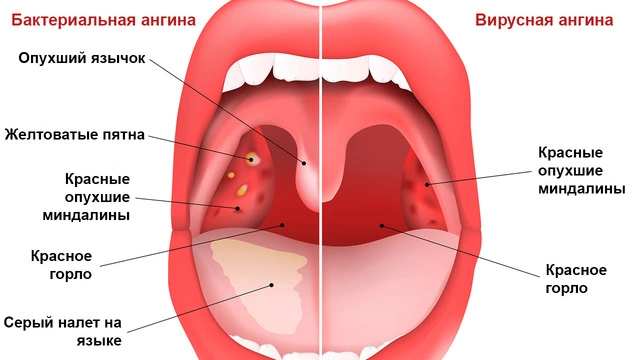 Симптомы ангины бактериального и вирусного происхождения.