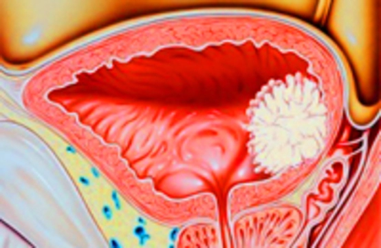 Злокачественные опухоли мочевыделительной системы
