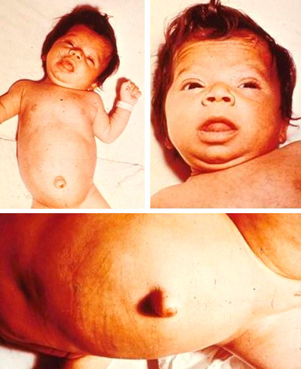 Врожденный гипотериоз у ребенка