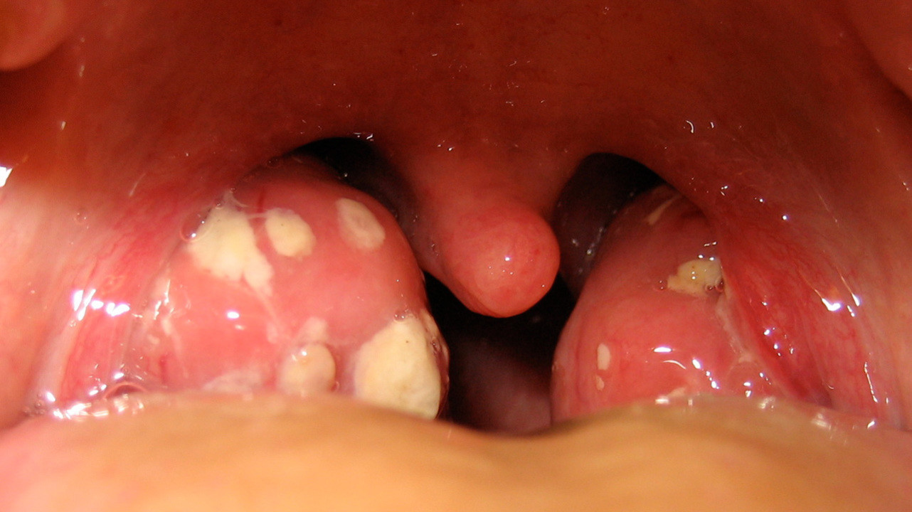 Абсцесс полости рта — острое гнойное воспаление