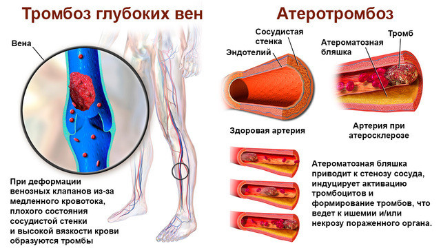 Тромбоз артерия и вена