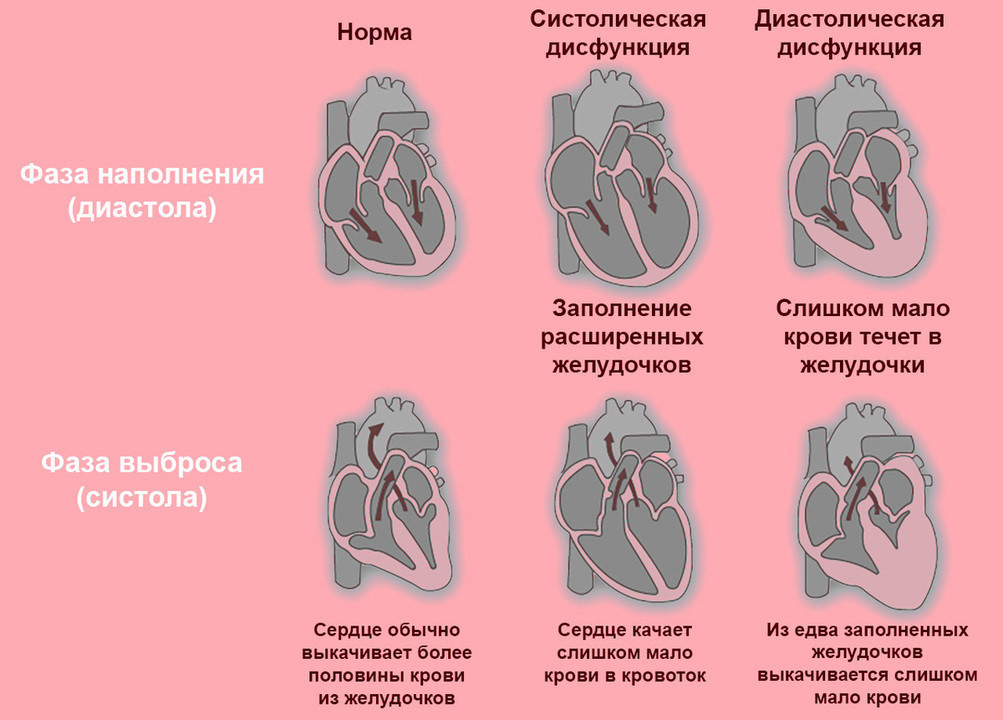 Хроническая сердечная недостаточность презентация