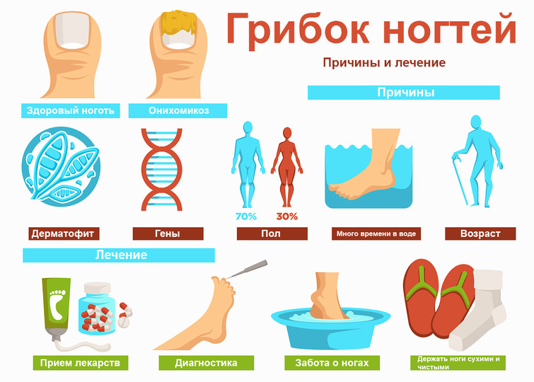 Онихомикоз (грибок ногтя): причины заболевания, виды, симптомы