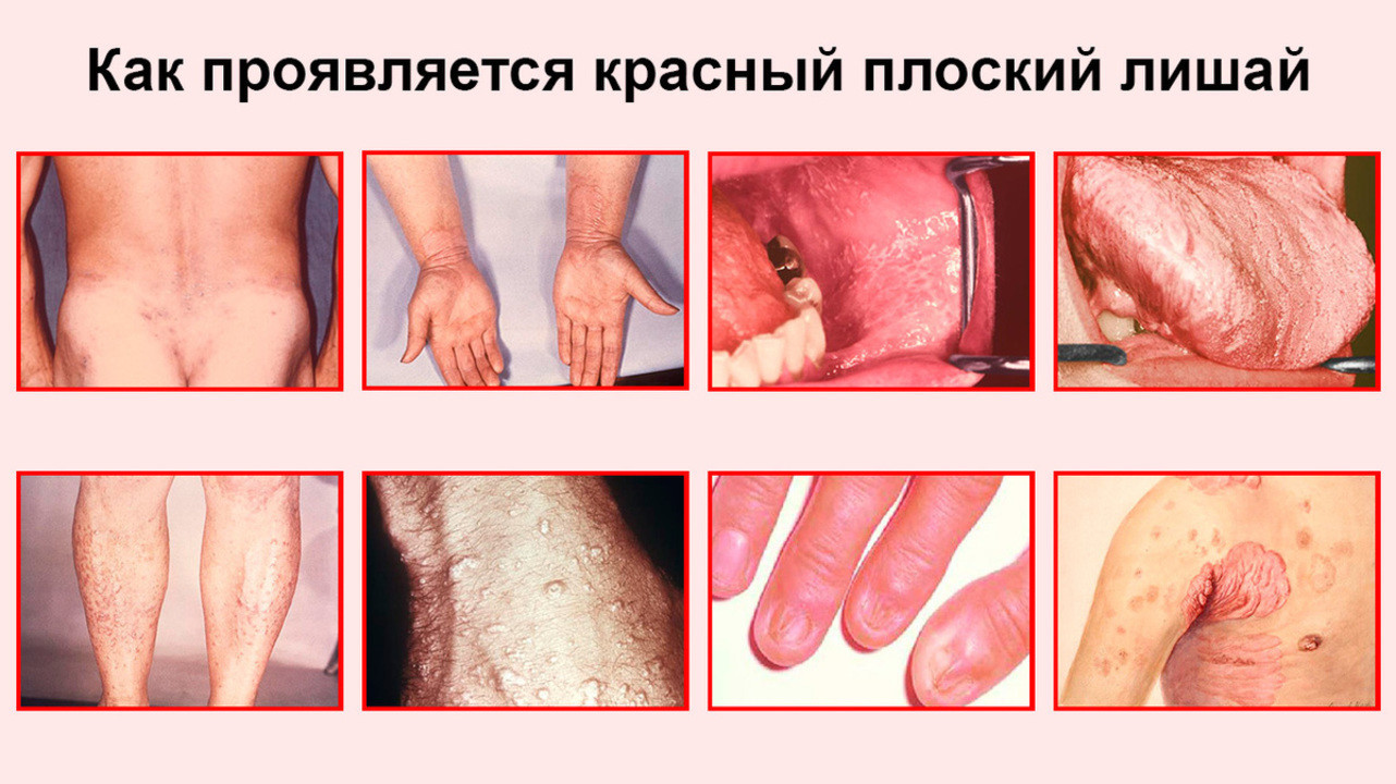 Красный плоский лишай - симптомы и лечение