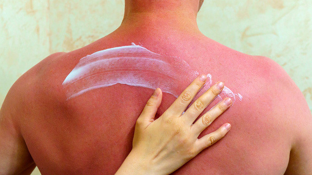 Солнечный ожог кожи: первая помощь, лечение, степени