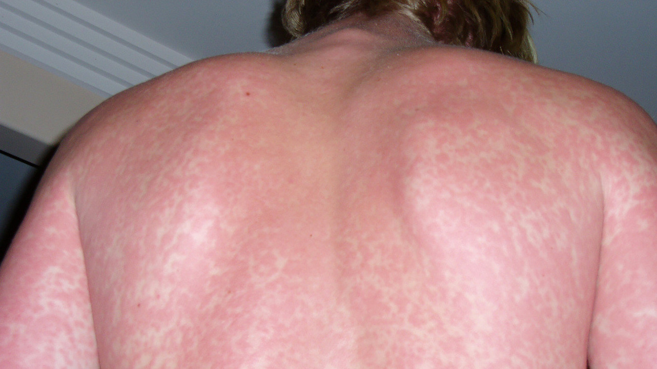 Аллергии - симптомы и признаки, виды, что делать при аллергии