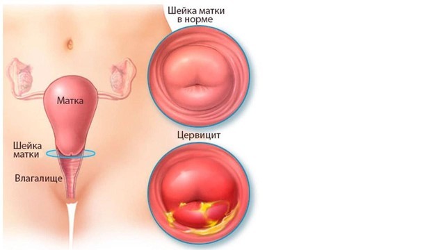 Ureaplasma parvum норма у женщин в мазке