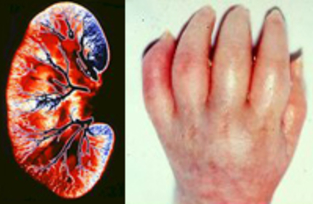 Острая почечная недостаточность. Урология