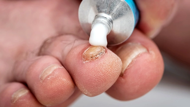 Онихомикоз (грибок ногтей) - причины, симптомы и лечение