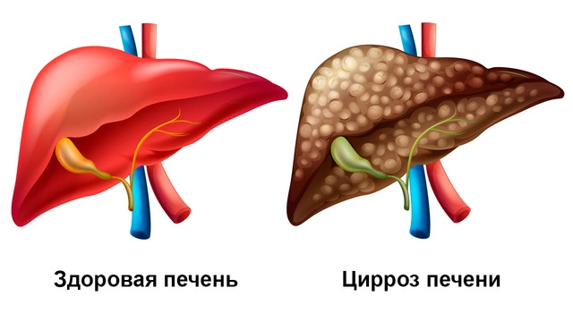 Здоровая печень и печень, пораженная циррозом Слева изображена здоровая печень, которая имеет гладкую и блестящую поверхность. Справа изображена печень, пораженная циррозом, она имеет бугристый вид