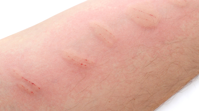 Осложнения прививок. Инфекционные болезни