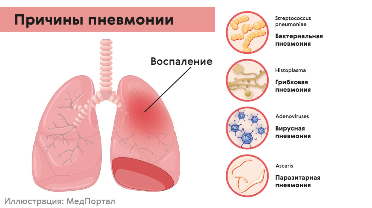 Причины развития пневмонии